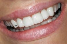 Save $400 on a Teeth Whitening Treatment! Christchurch Central (8011) Dental _small