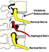Vertebral Subluxation - Nerve compression