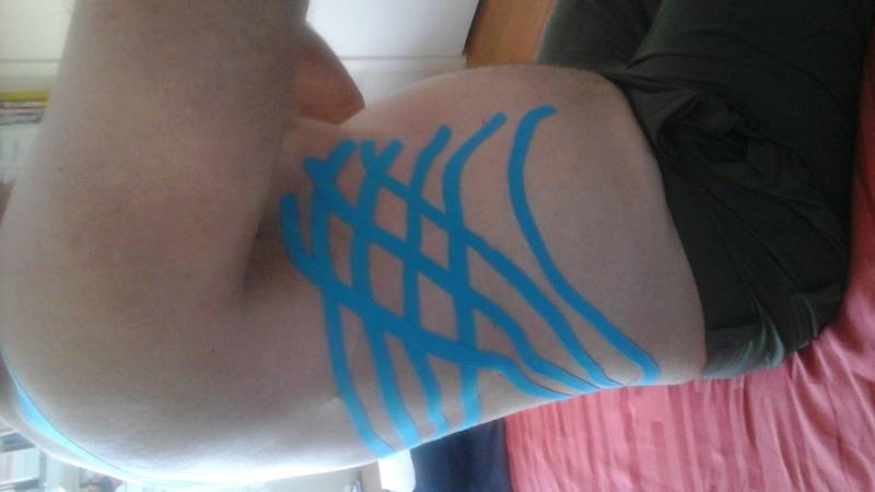 Kinesio-taping for Lymphoedema of the body