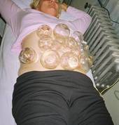 static cupping/moving cupping, its a wonderful way to remove stagnation of blood, fluids,Qi,