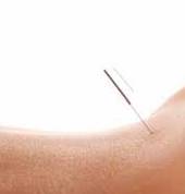Acupuncture