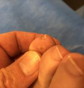 Interdigital pressure lesion