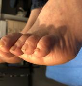Fixed toe deformity