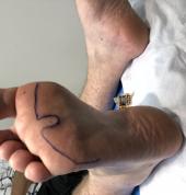 Ouline of pressure pad relief